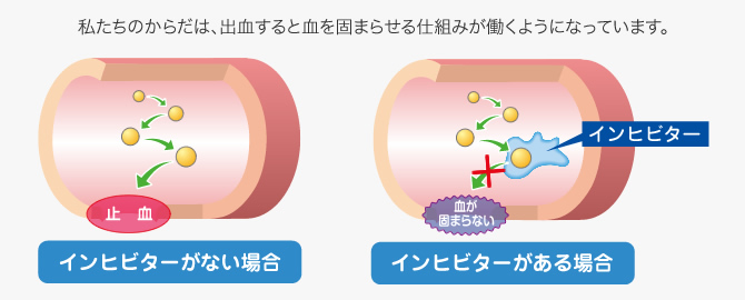 インヒビターがない場合とインヒビターがある場合の違い