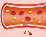 血友病患者さんの血液の固まり方：図１