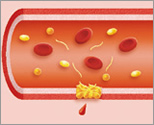 血友病患者さんの血液の固まり方：図３