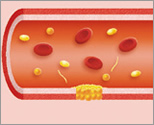 血友病患者さんの血液の固まり方：図４