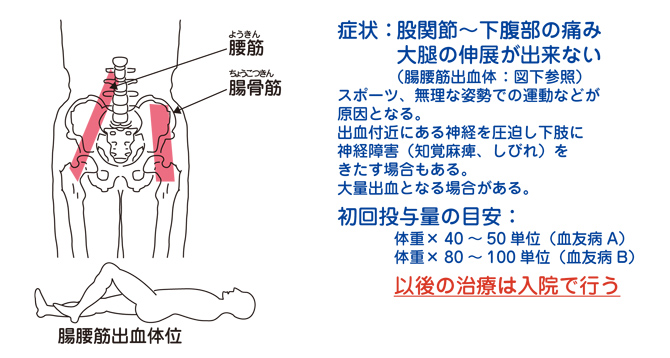 筋肉内出血 腸腰筋出血 出血時補充療法 出血の種類と初期投与量 ヘモフィリアステーション