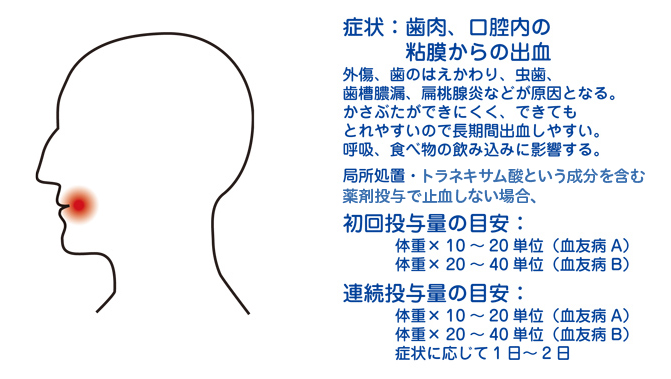 口腔内出血 血友病の症状 ヘモフィリアステーション